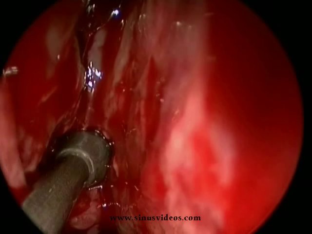 CSF Leak Repair of Sphenoid Sinus after Pituitary Surgery